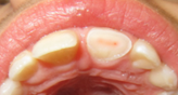 Knækket tand, hvor nerven kan ses i midten